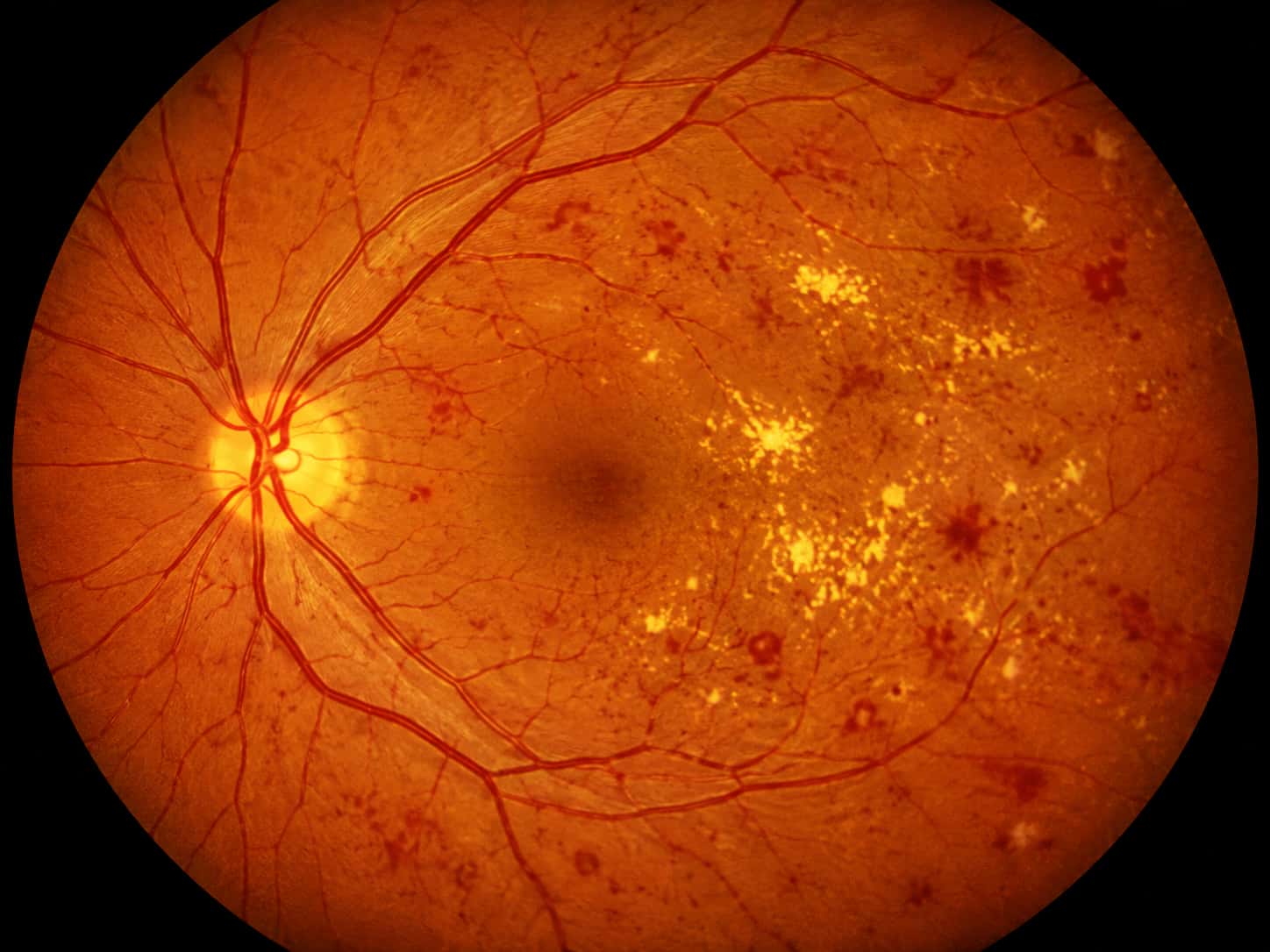 diabetic & hypertensive retinopathy